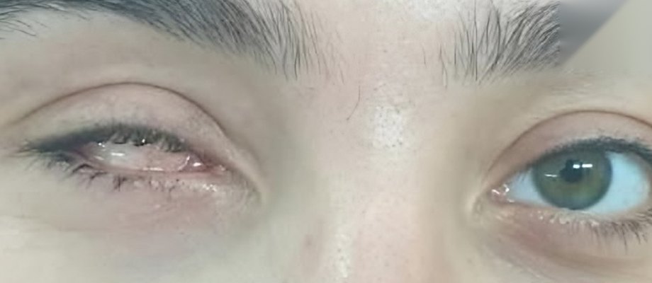 قبل تركيب العين الصناعية: عين خضرا مرسومة باليد على درجة العين الطبيعية