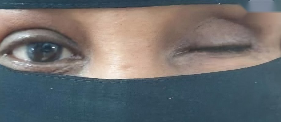 قبل تركيب العين الصناعية: نظرة طبيعية ومتناسقة