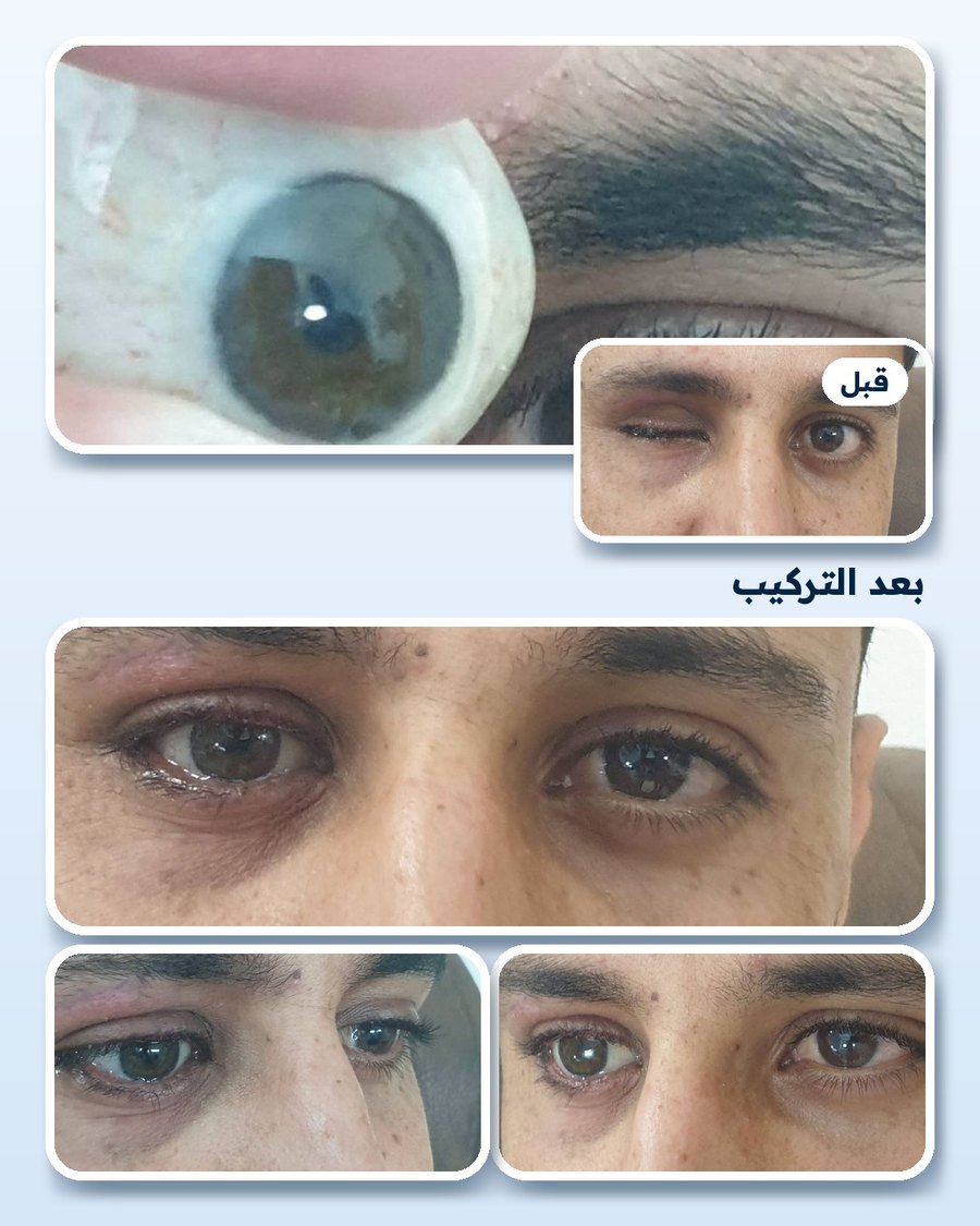 قبل وبعد تركيب العين الصناعية: عين بنية على درجة العين الطبيعية