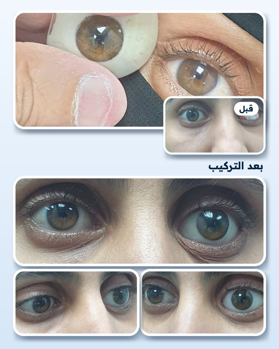 قبل وبعد تركيب العين الصناعية: نظرة طبيعية ومتناسقة