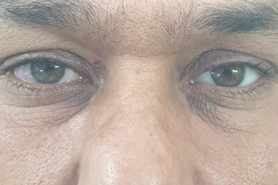 بعد التركيب: عين صناعية متناسقة مع العين التانية في اللون والحجم