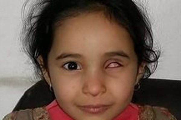 قبل التركيب: طفلة قبل وبعد تركيب العين الصناعية