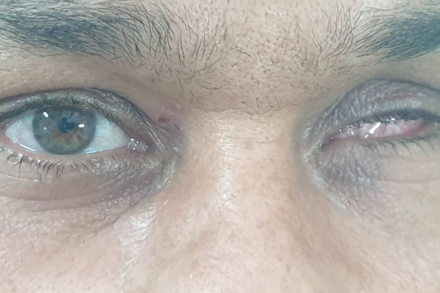 قبل التركيب: عين صناعية متناسقة مع العين التانية في اللون والحجم